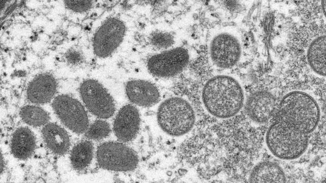 Rio Grande do Sul tem dois casos confirmados e seis suspeitos de Monkeypox