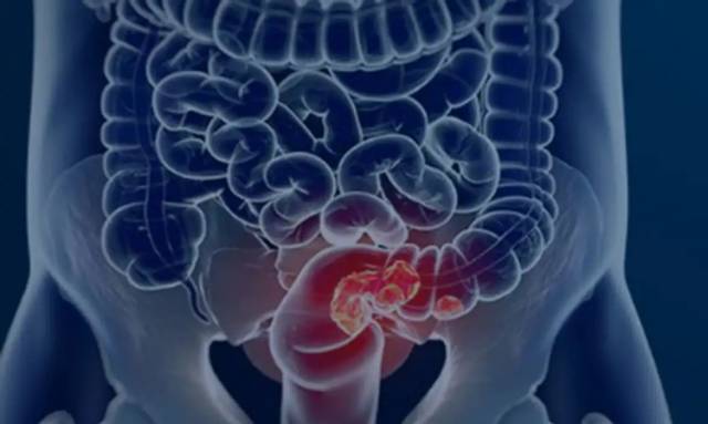 Câncer de intestino é tema da I Jornada Oncológica Multiprofissional do Vida & Saúde